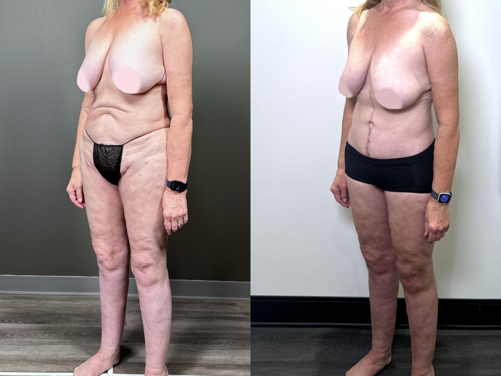 Before & After Drainless Tummy Tuck Case 87 Left Oblique View in Atlanta, GA