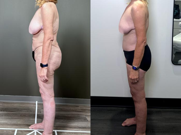 Before & After Drainless Tummy Tuck Case 87 Left Side View in Atlanta, GA