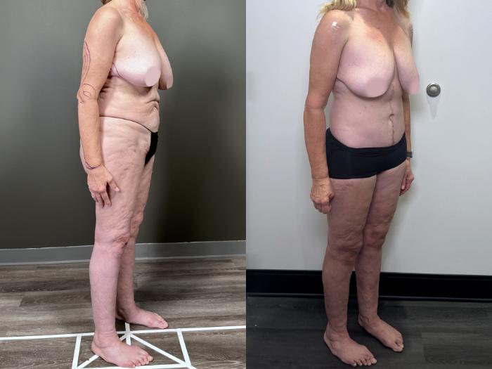Before & After Drainless Tummy Tuck Case 87 Right Oblique View in Atlanta, GA