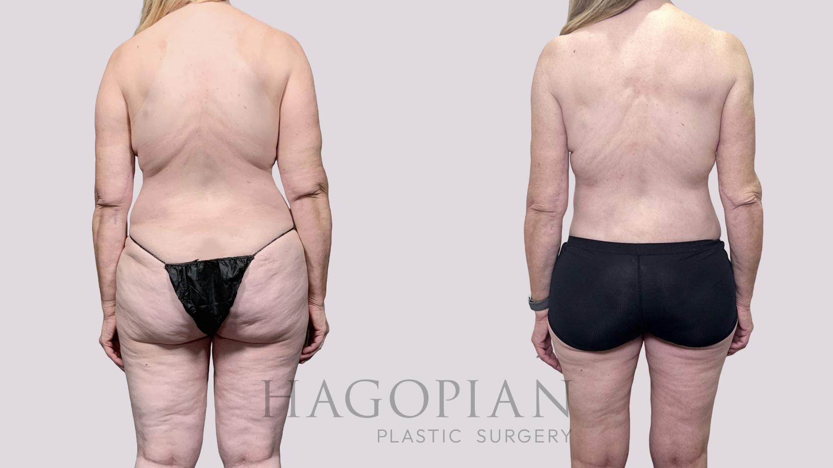 Before & After Drainless Tummy Tuck Case 89 Back View in Atlanta, GA