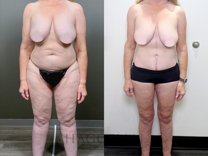 Before & After Drainless Tummy Tuck Case 89 Front View in Atlanta, GA