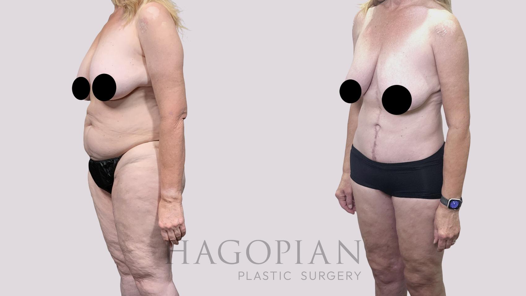 Before & After Drainless Tummy Tuck Case 89 Left Oblique View in Atlanta, GA