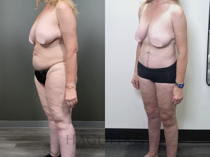Before & After Drainless Tummy Tuck Case 89 Left Oblique View in Atlanta, GA