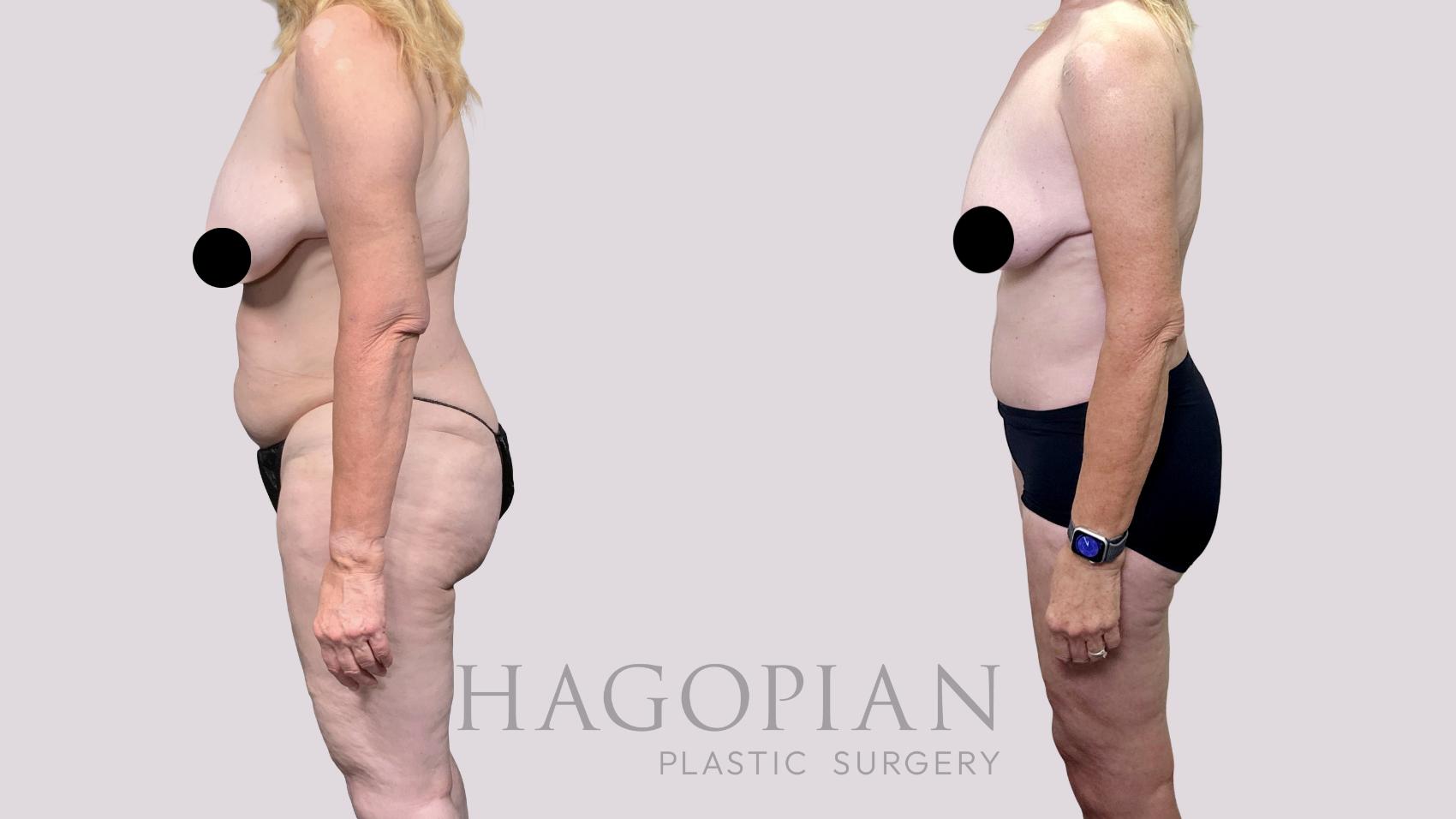 Before & After Drainless Tummy Tuck Case 89 Left Side View in Atlanta, GA