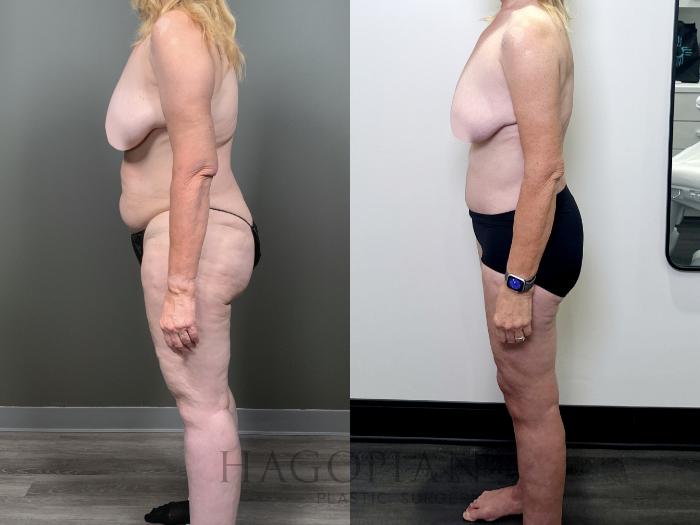 Before & After Drainless Tummy Tuck Case 89 Left Side View in Atlanta, GA