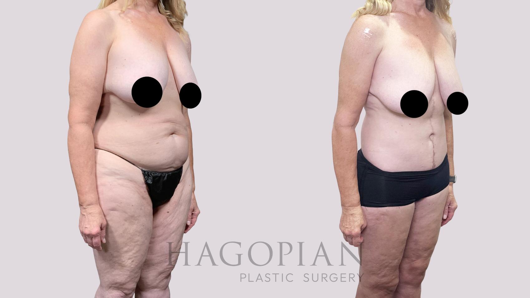 Before & After Drainless Tummy Tuck Case 89 Right Oblique View in Atlanta, GA