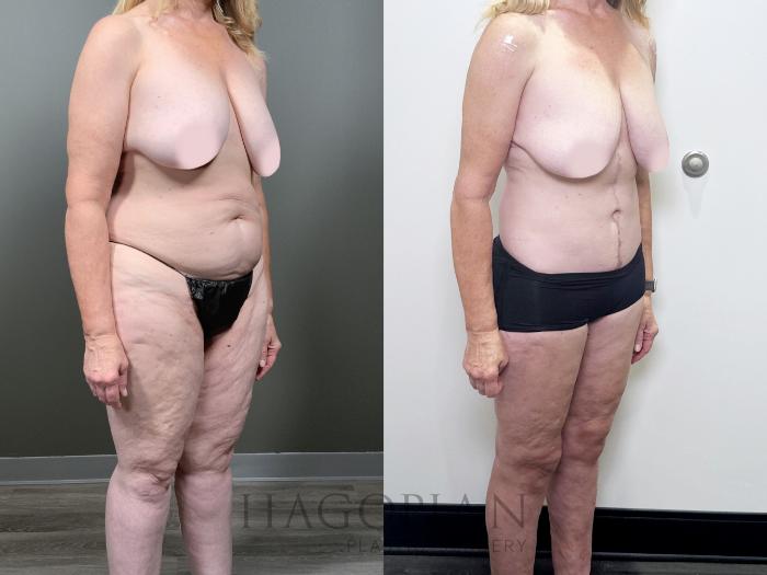 Before & After Drainless Tummy Tuck Case 89 Right Oblique View in Atlanta, GA