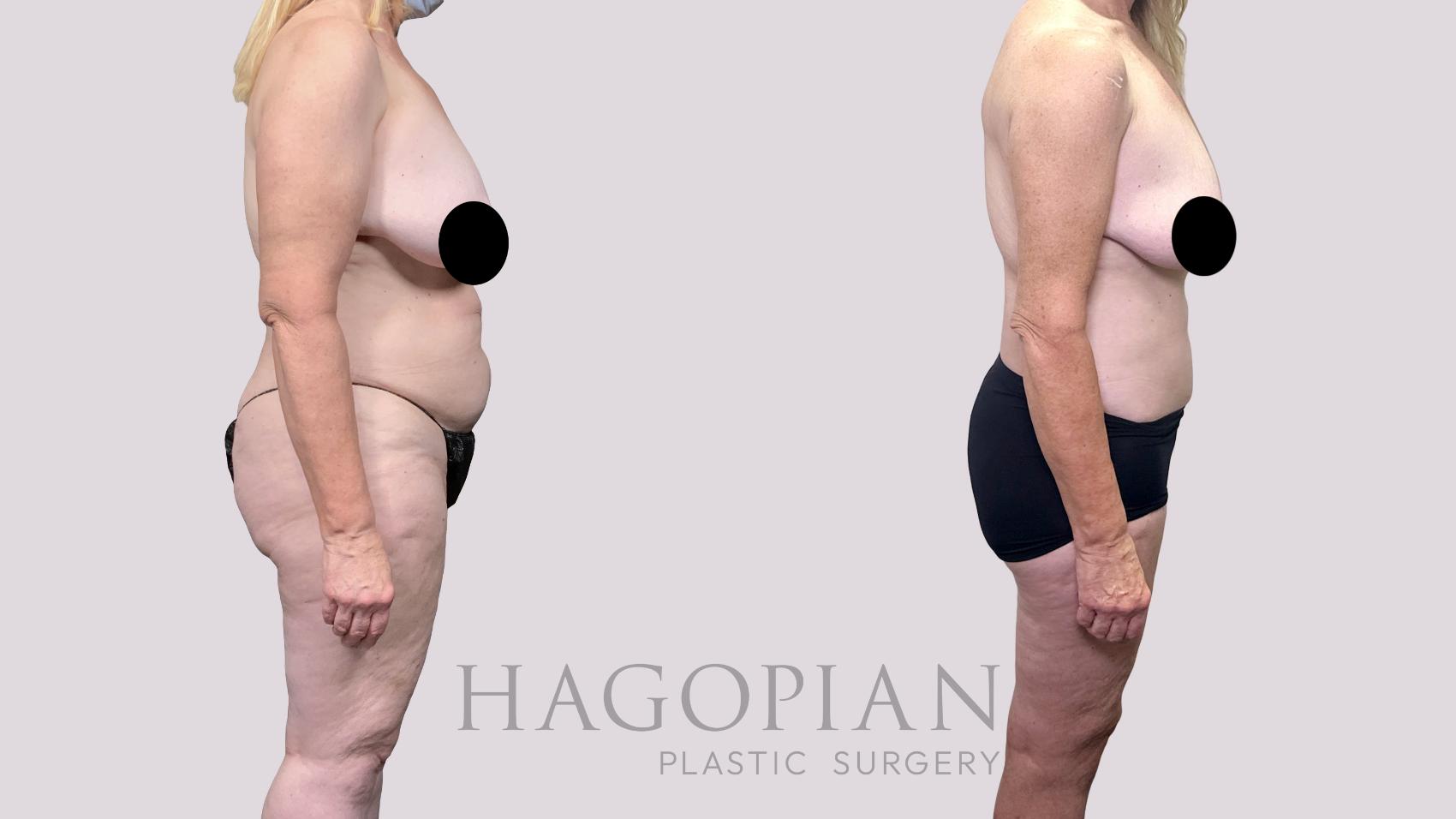 Before & After Drainless Tummy Tuck Case 89 Right Side View in Atlanta, GA