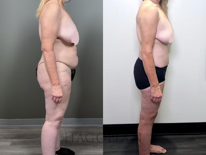 Before & After Drainless Tummy Tuck Case 89 Right Side View in Atlanta, GA