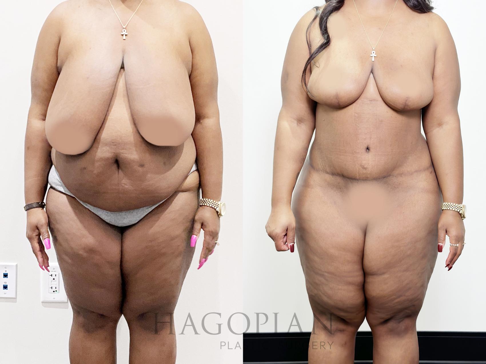 Before & After Drainless Tummy Tuck Case 92 Front View in Atlanta, GA