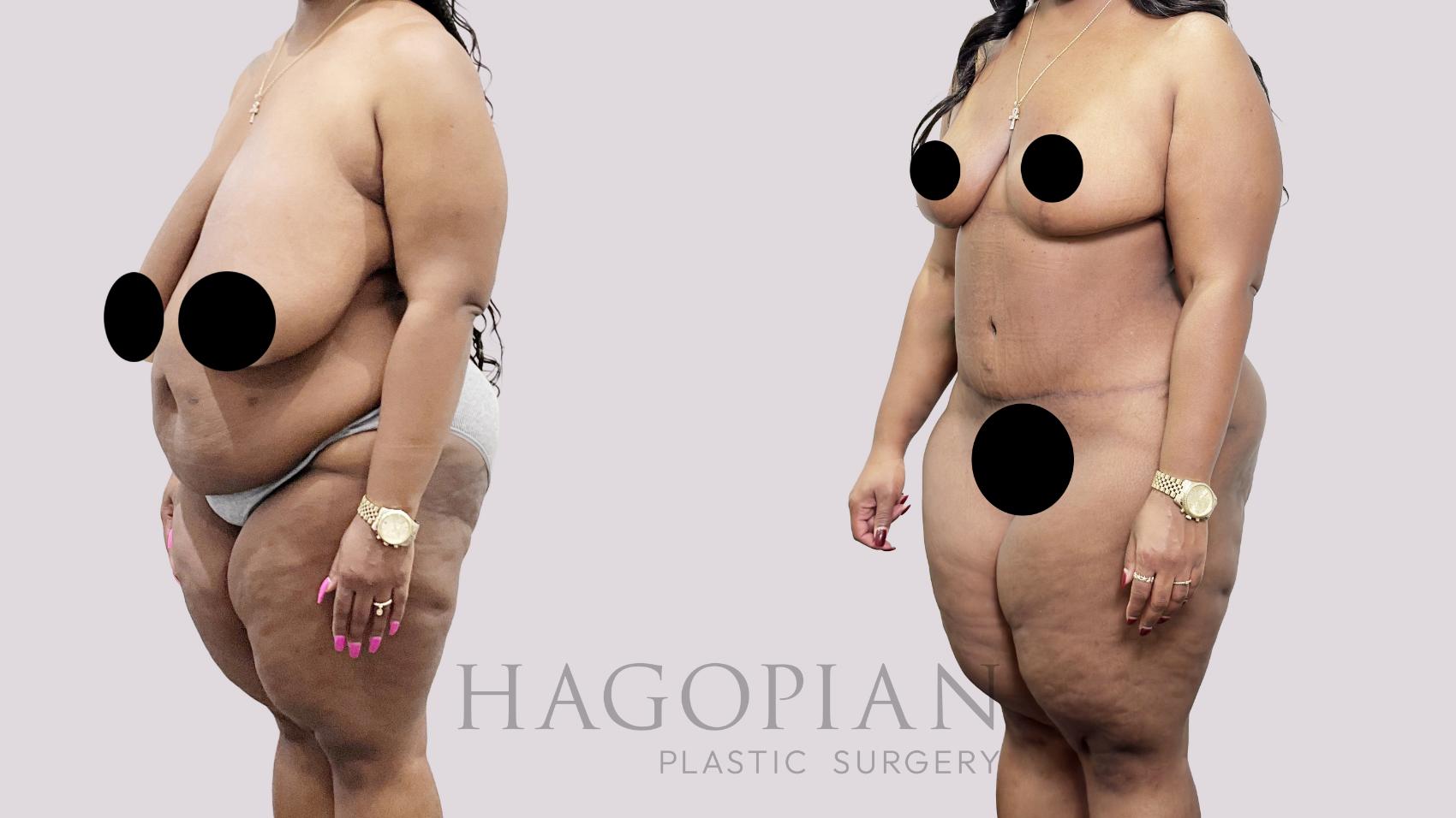 Before & After Drainless Tummy Tuck Case 92 Left Oblique View in Atlanta, GA