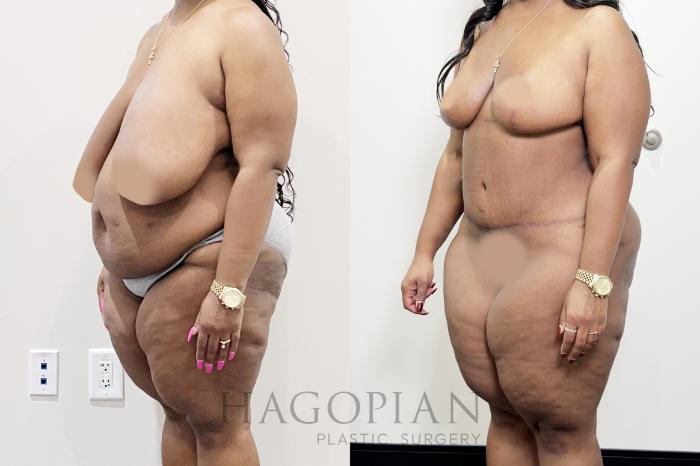 Before & After Drainless Tummy Tuck Case 92 Left Oblique View in Atlanta, GA