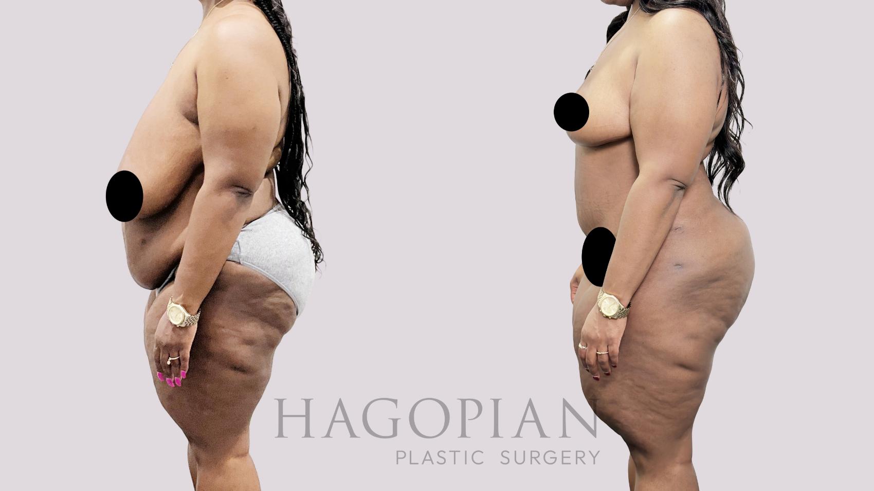 Before & After Drainless Tummy Tuck Case 92 Left Side View in Atlanta, GA