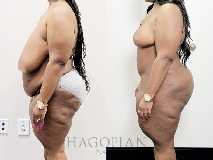 Before & After Drainless Tummy Tuck Case 92 Left Side View in Atlanta, GA