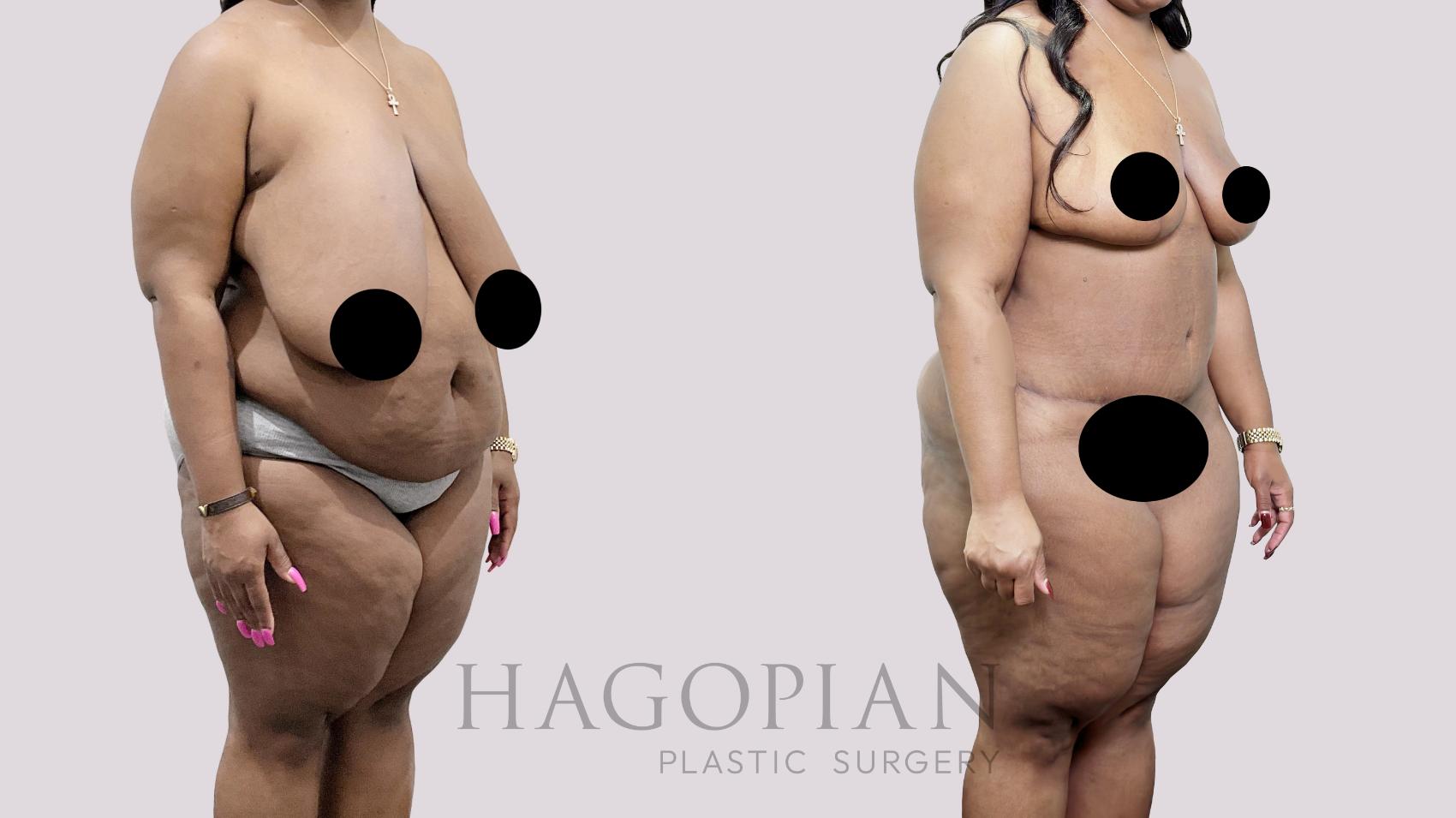 Before & After Drainless Tummy Tuck Case 92 Right Oblique View in Atlanta, GA