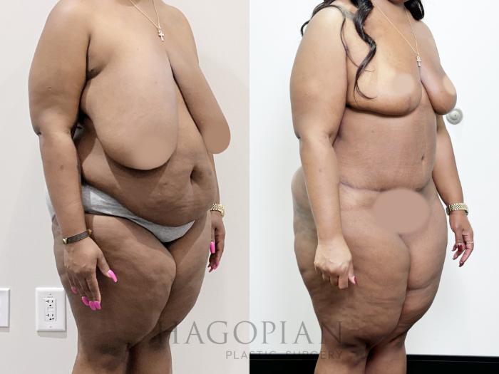 Before & After Drainless Tummy Tuck Case 92 Right Oblique View in Atlanta, GA
