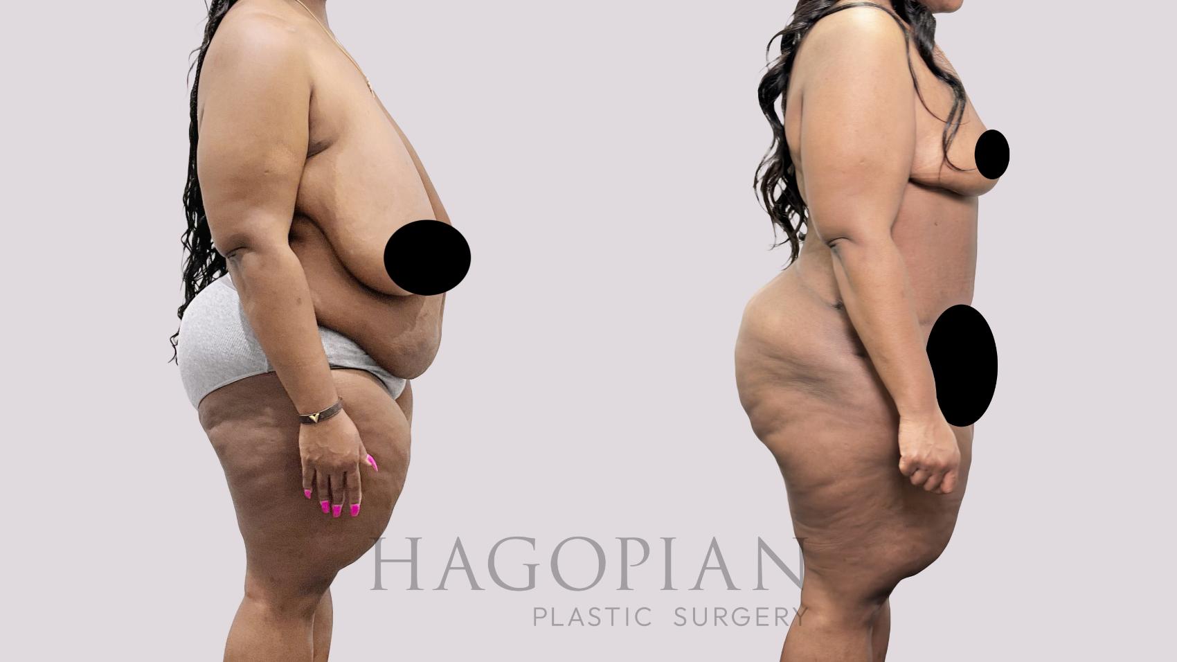 Before & After Drainless Tummy Tuck Case 92 Right Side View in Atlanta, GA