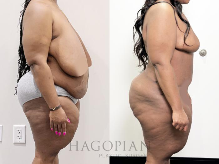 Before & After Drainless Tummy Tuck Case 92 Right Side View in Atlanta, GA