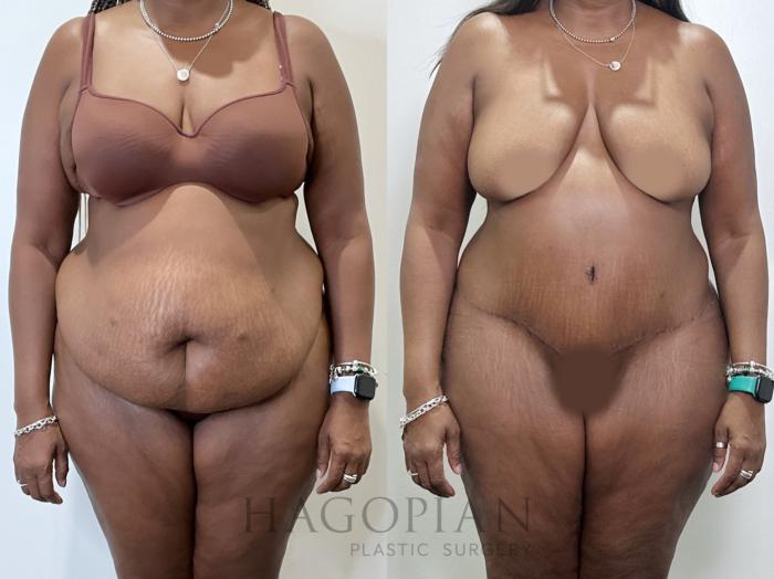 Before & After Drainless Tummy Tuck Case 95 Front View in Atlanta, GA