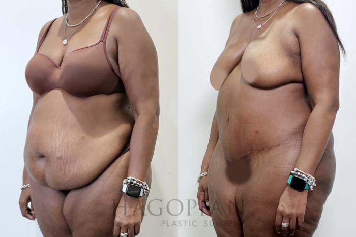 Before & After Drainless Tummy Tuck Case 95 Left Oblique View in Atlanta, GA
