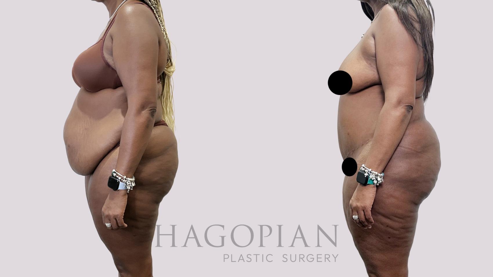 Before & After Drainless Tummy Tuck Case 95 Left Side View in Atlanta, GA