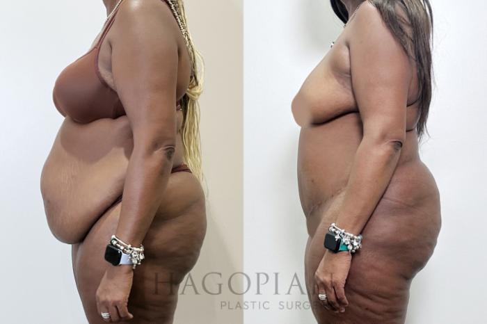 Before & After Drainless Tummy Tuck Case 95 Left Side View in Atlanta, GA