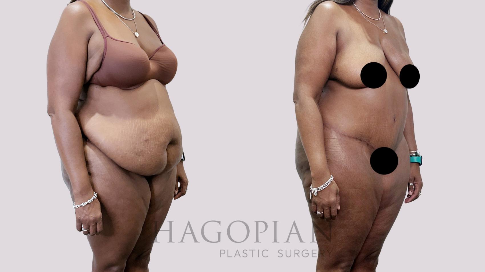 Before & After Drainless Tummy Tuck Case 95 Right Oblique View in Atlanta, GA