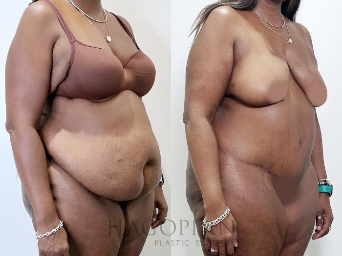 Before & After Drainless Tummy Tuck Case 95 Right Oblique View in Atlanta, GA