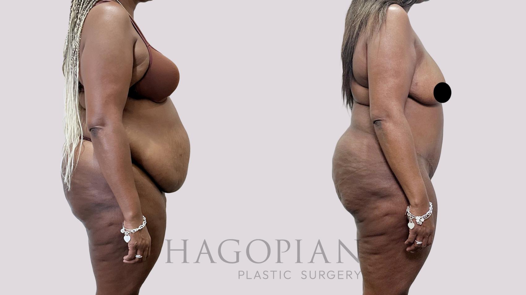 Before & After Drainless Tummy Tuck Case 95 Right Side View in Atlanta, GA