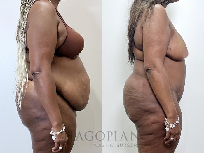 Before & After Drainless Tummy Tuck Case 95 Right Side View in Atlanta, GA