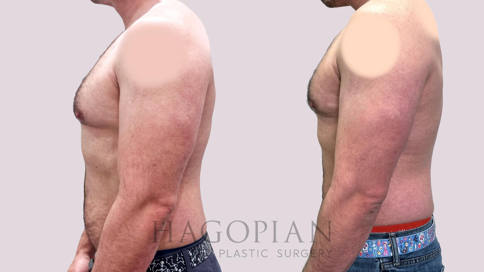 Before & After Gynecomastia Surgery Case 98 Left Side View in Atlanta, GA