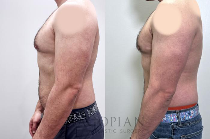 Before & After Gynecomastia Surgery Case 98 Left Side View in Atlanta, GA