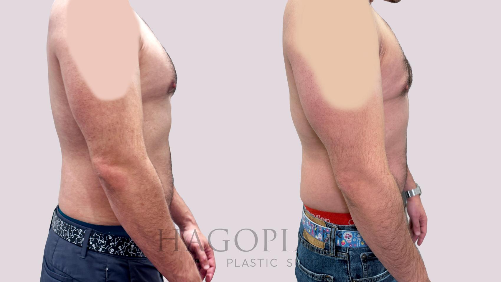 Before & After Gynecomastia Surgery Case 98 Right Side View in Atlanta, GA
