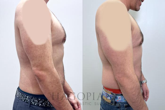 Before & After Gynecomastia Surgery Case 98 Right Side View in Atlanta, GA