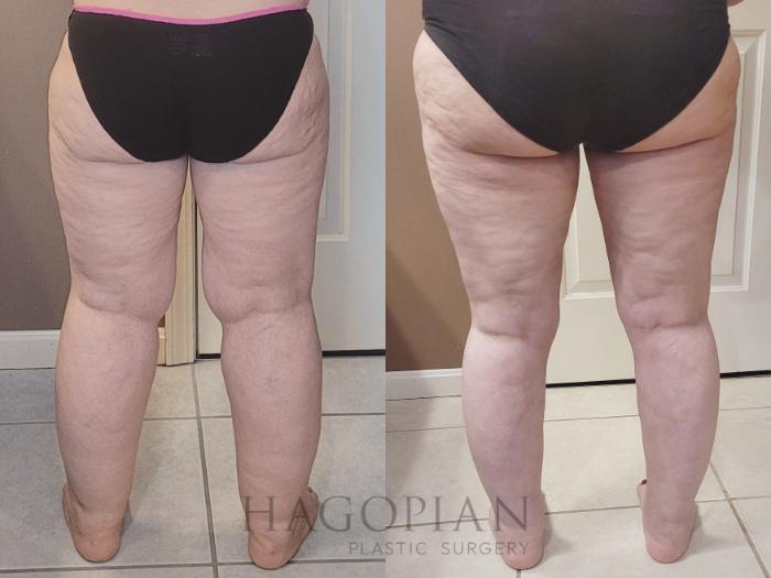 Before & After Lipedema Surgery Case 114 Back View in Atlanta, GA