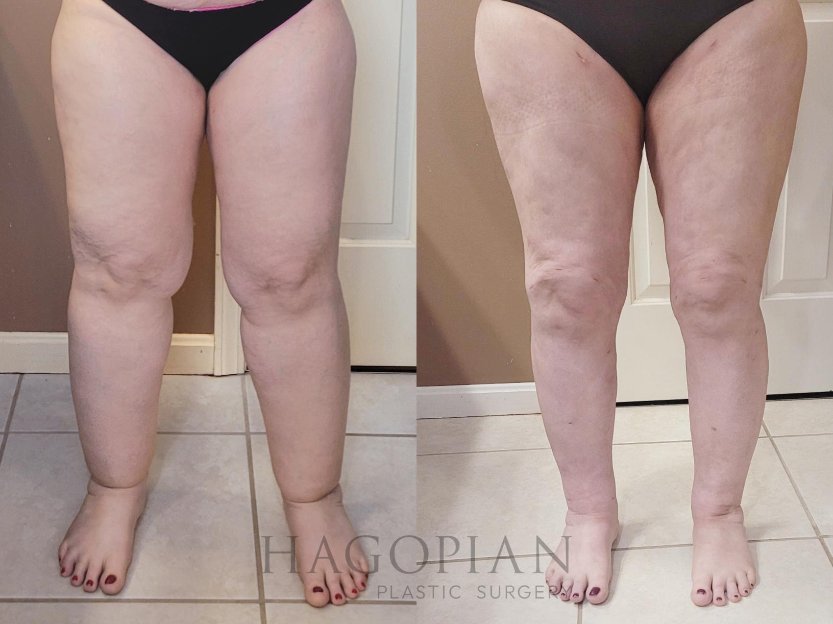Before & After Lipedema Surgery Case 114 Front View in Atlanta, GA