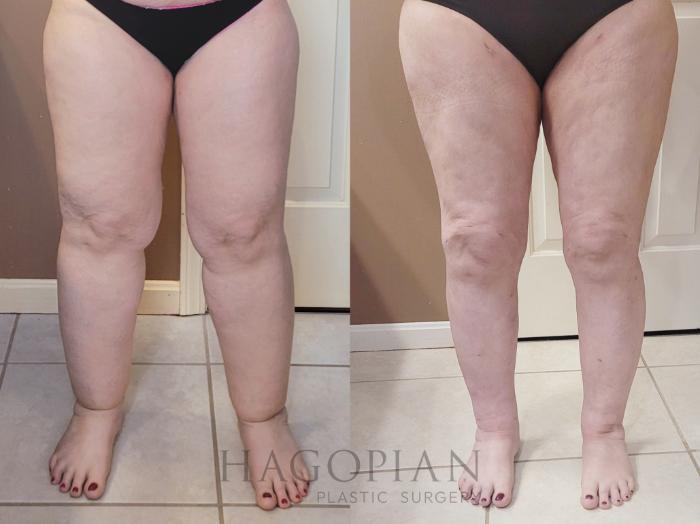 Before & After Lipedema Surgery Case 114 Front View in Atlanta, GA