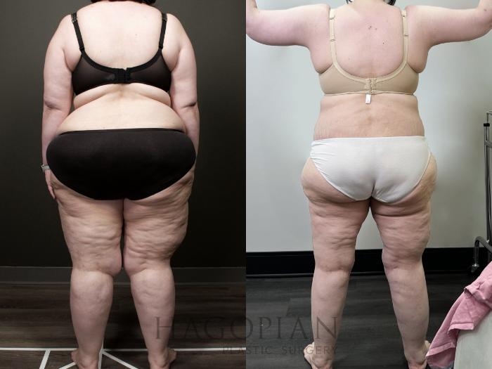 Before & After Lipedema Surgery Case 118 Back View in Atlanta, GA