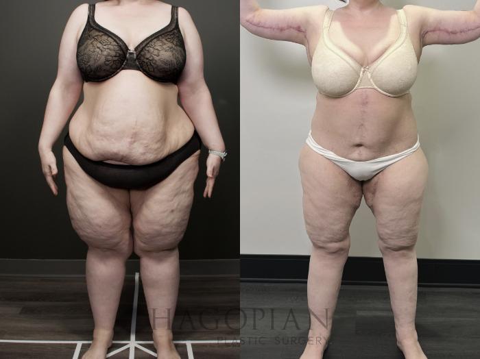 Before & After Lipedema Surgery Case 118 Front View in Atlanta, GA