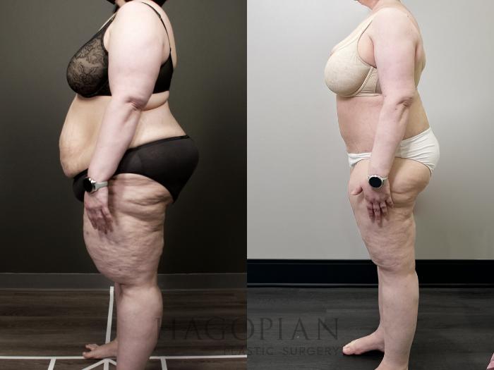 Before & After Lipedema Surgery Case 118 Left Side View in Atlanta, GA