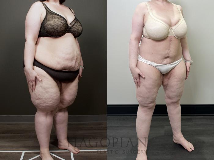 Before & After Lipedema Surgery Case 118 Right Oblique View in Atlanta, GA