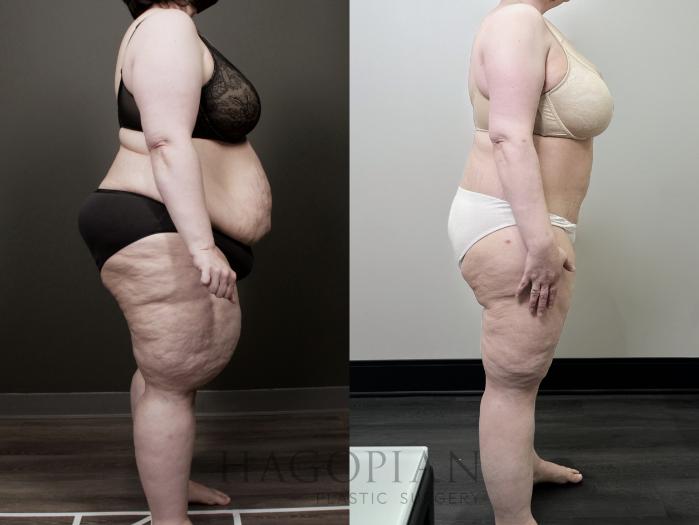 Before & After Lipedema Surgery Case 118 Right Side View in Atlanta, GA