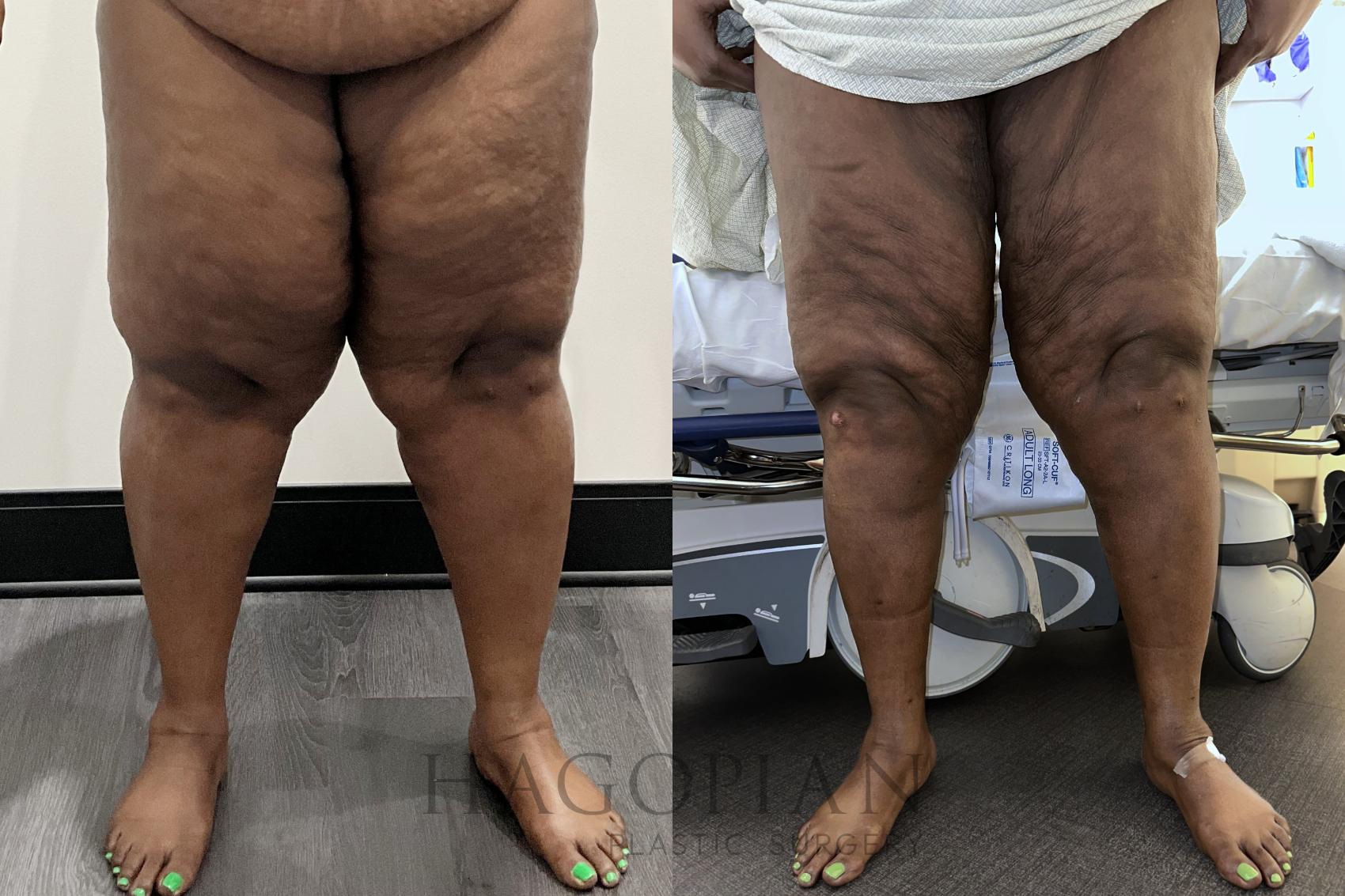 Before & After Lipedema Surgery Case 121 Front View in Atlanta, GA