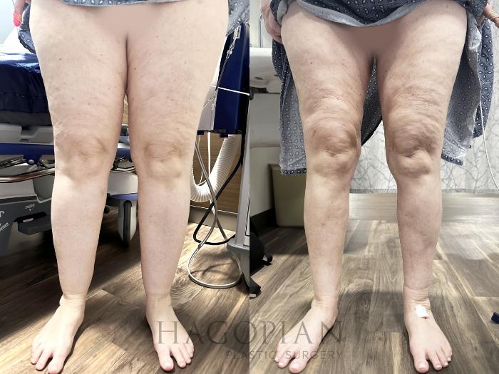 Before & After Lipedema Surgery Case 125 Front View in Atlanta, GA
