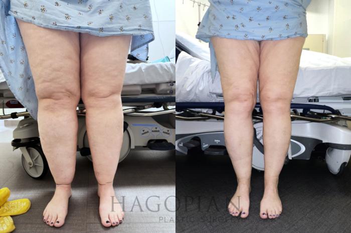 Before & After Lipedema Surgery Case 126 Front View in Atlanta, GA