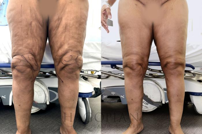 Before & After Lipedema Surgery Case 127 Front View in Atlanta, GA