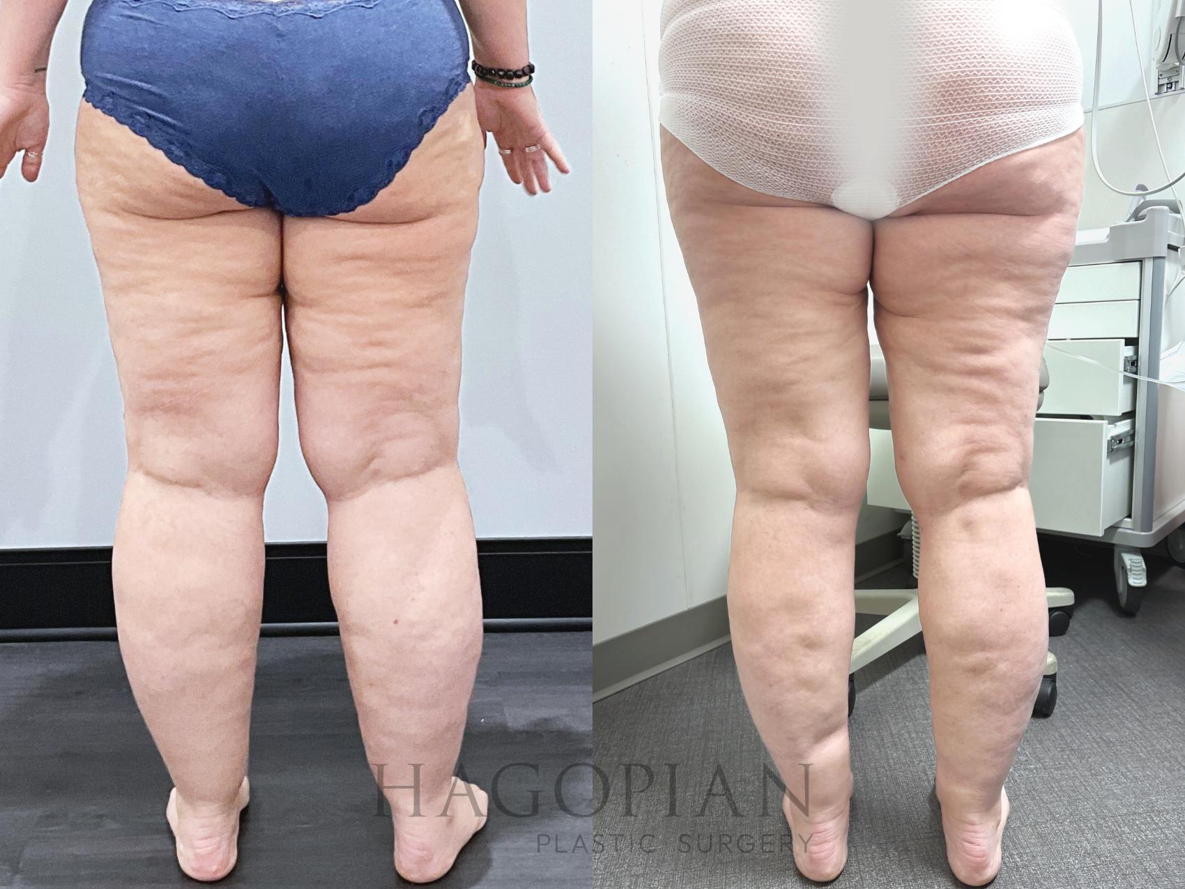 Before & After Lipedema Surgery Case 133 Back View in Atlanta, GA