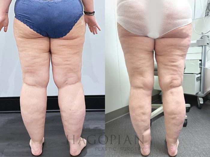 Before & After Lipedema Surgery Case 133 Back View in Atlanta, GA