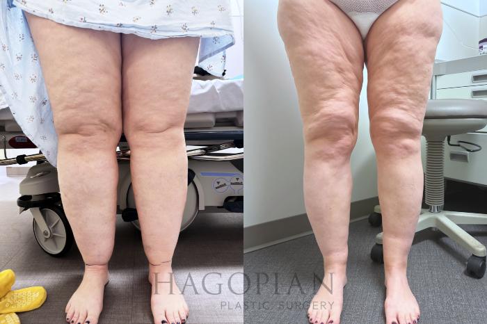 Before & After Lipedema Surgery Case 133 Front View in Atlanta, GA