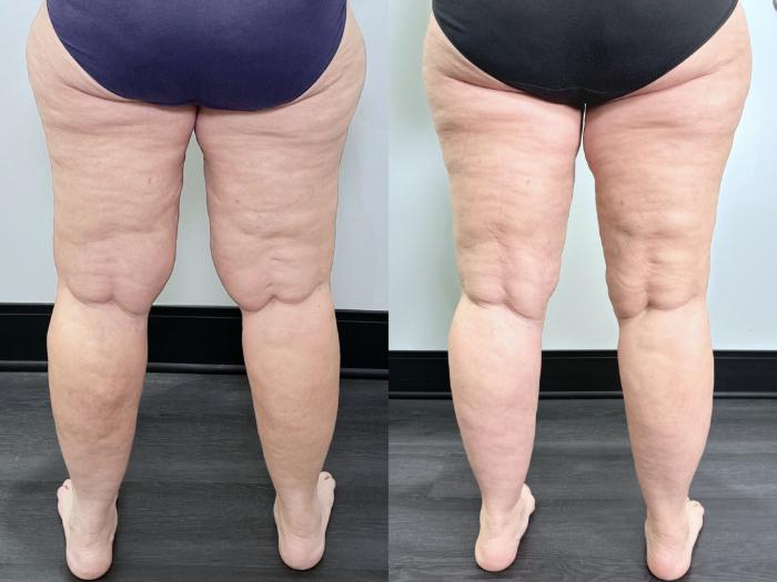 Before & After Lipedema Surgery Case 134 Back View in Atlanta, GA